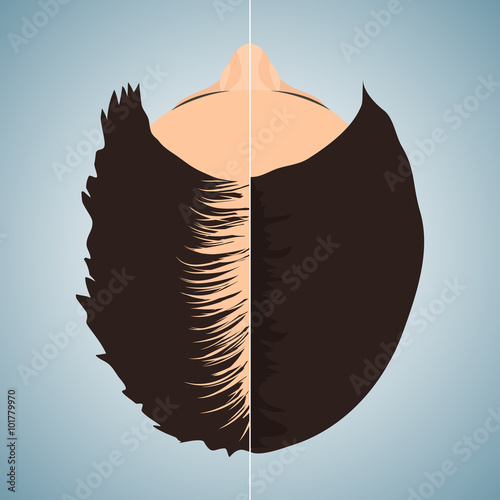 Top view of a woman losing hair before and after hair treatment and hair transplantation. Divided image of a woman's head. Two halves. Female hair loss. Hair care concept. Isolated vector illustration