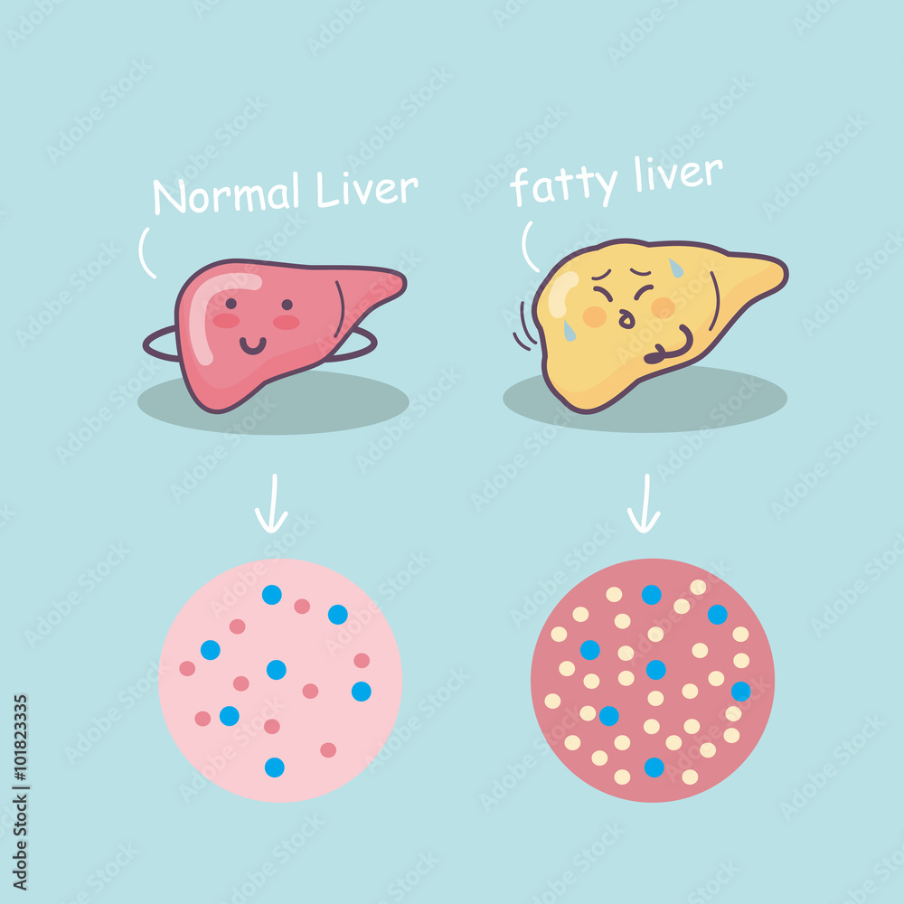 Health liver vs Fatty liver
