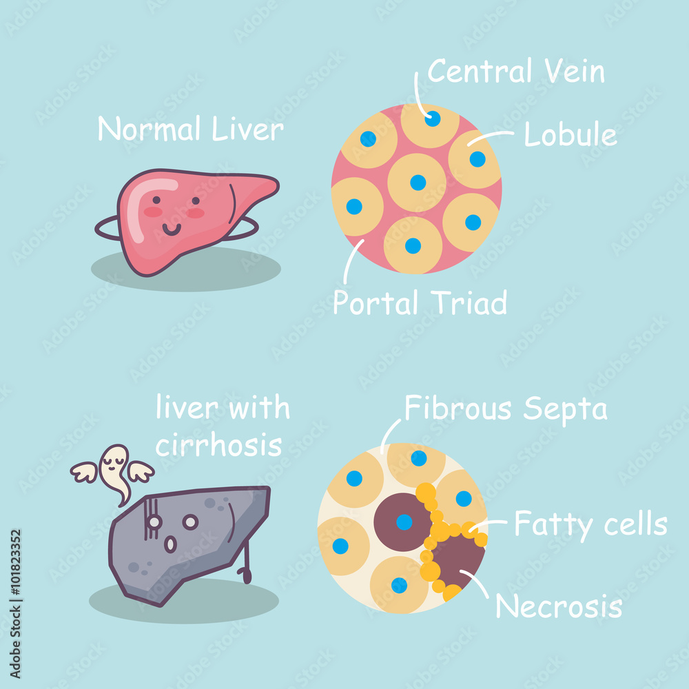 Health liver vs cirrhosis liver