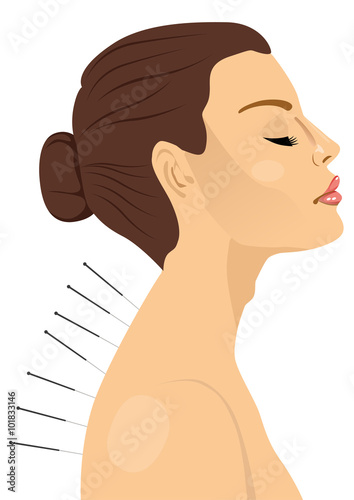 woman getting an acupuncture treatment