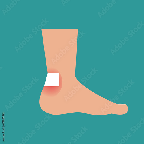 Callus on the foot. Vector Illustration