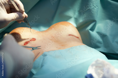 breast augmentation surgery in the operating room surgeon tools implant