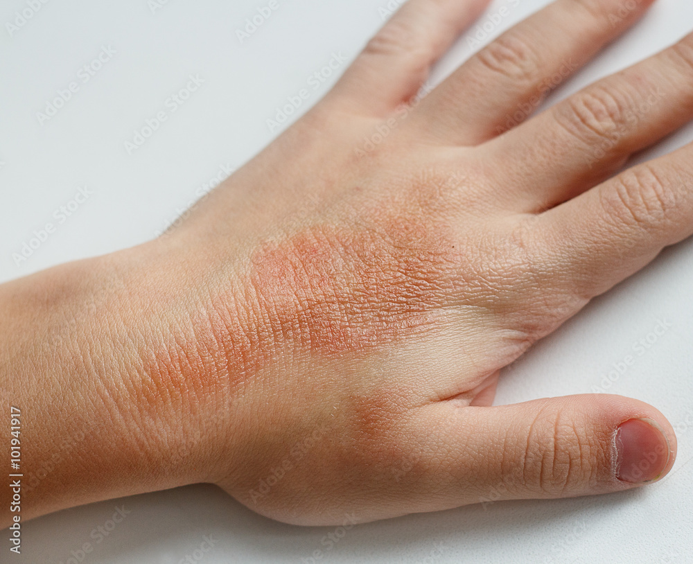 red-spots-on-child-hands-skin-covered-with-moisture-cream-the-cause-is