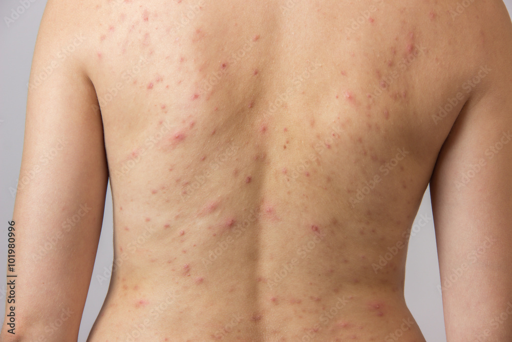 White acne deals