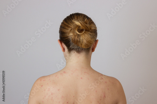 Young girl with acne, with red and white spots on the back