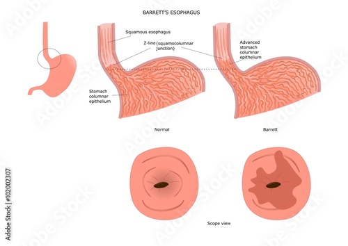 Barrett's esophagus: inflamed and injured portion of the esophagus