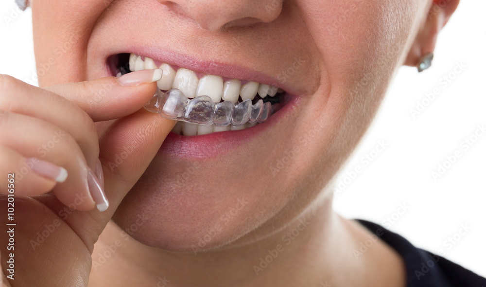 Fototapeta premium preventive teeth braces