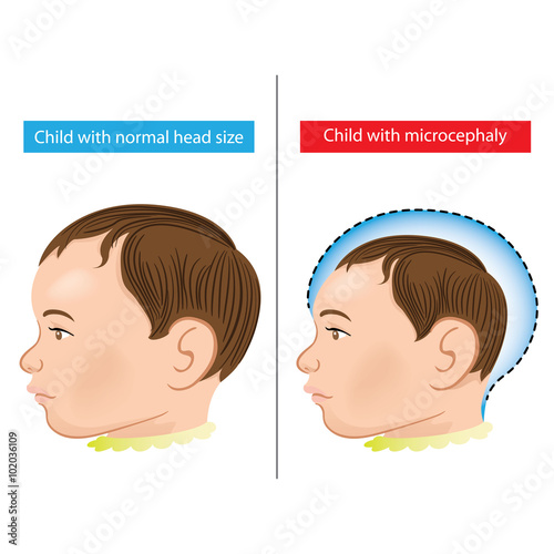 Illustration of a newborn baby with microcephaly disease caused by Zika virus