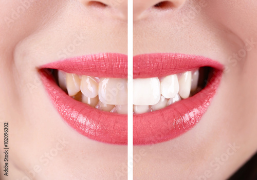 Smiling woman, teeth: before and after concept