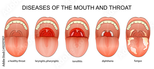 DISEASES OF THE THROAT photo