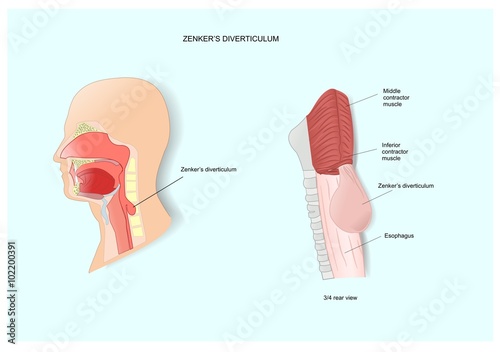 esophagus disease, the Zenker's diverticulum