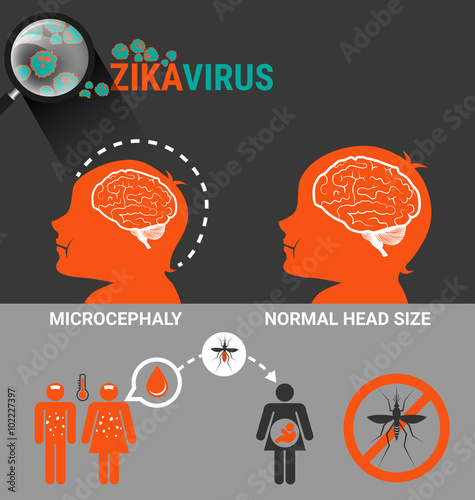 Pregnant Women with baby microcephaly and Zika Virus