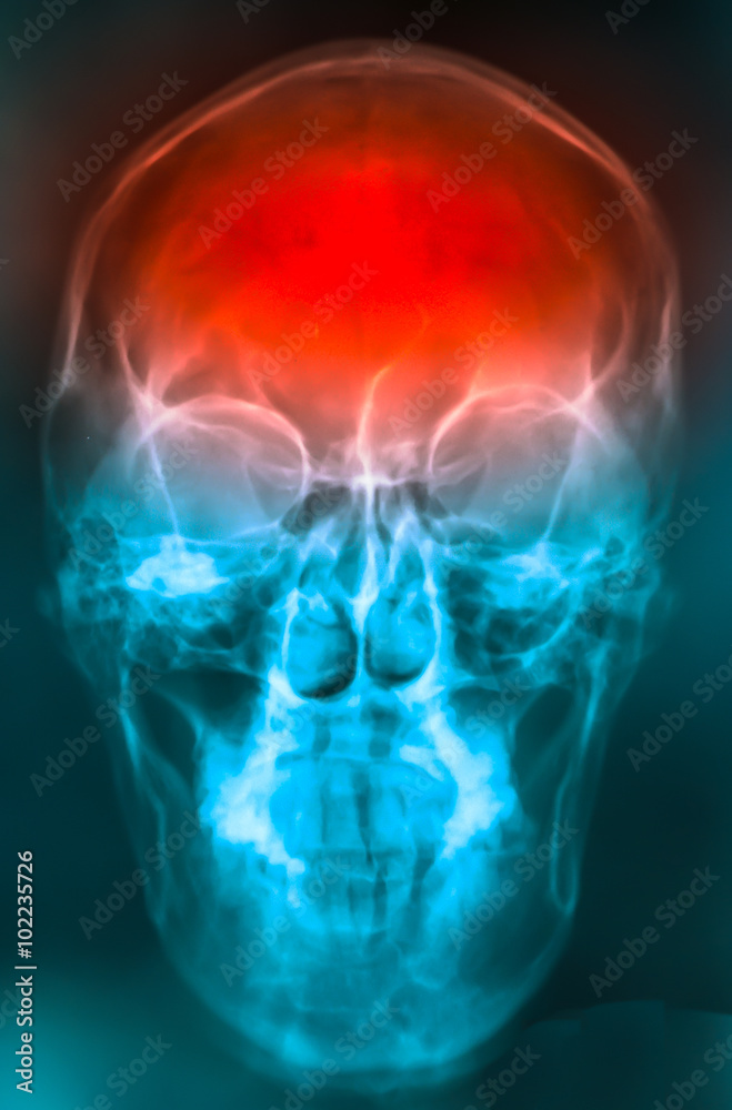 skull bone is show from skull radiography skull bone is show from skull radiography