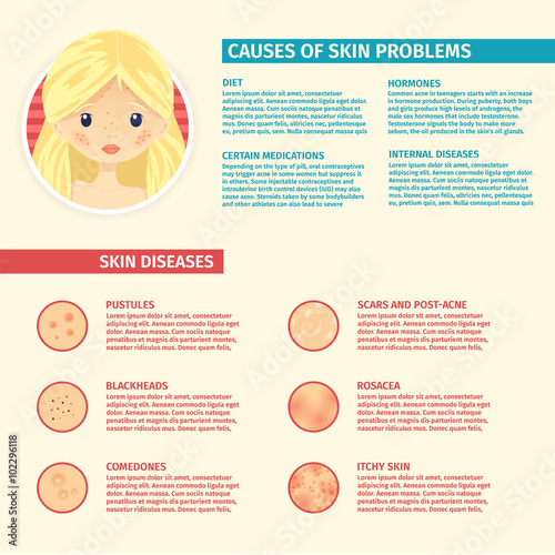 Infographics of skin problems, the causes of problem skin, types of problems. Blonde Girl with acne, pores, scars, pustules.