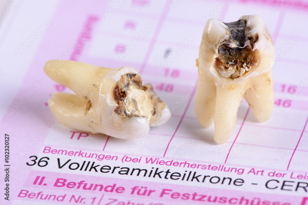 Backenzahn Weisheitszahn mit Karies auf Heil und Kostenplan StockFoto Adobe Stock