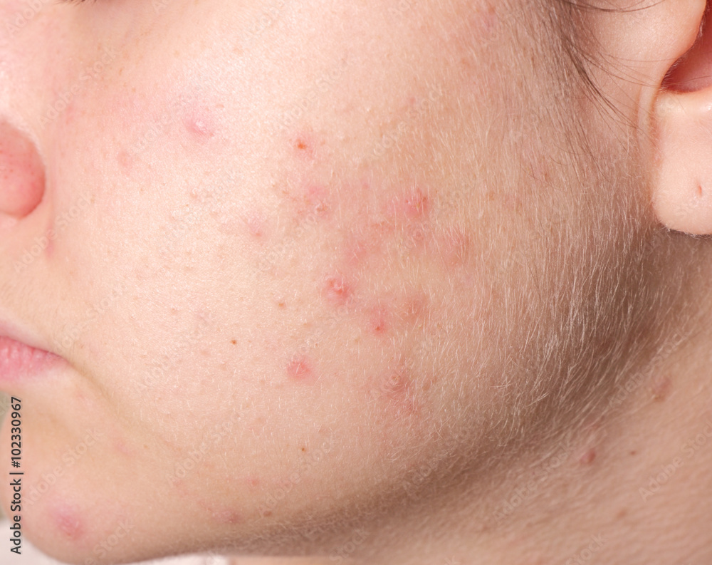 Acne on the girl's face Acne on the girl's face