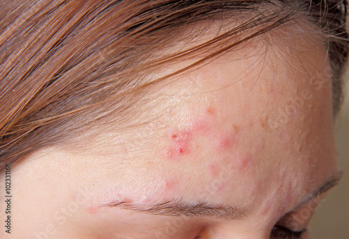 Acne on the girl's forehead