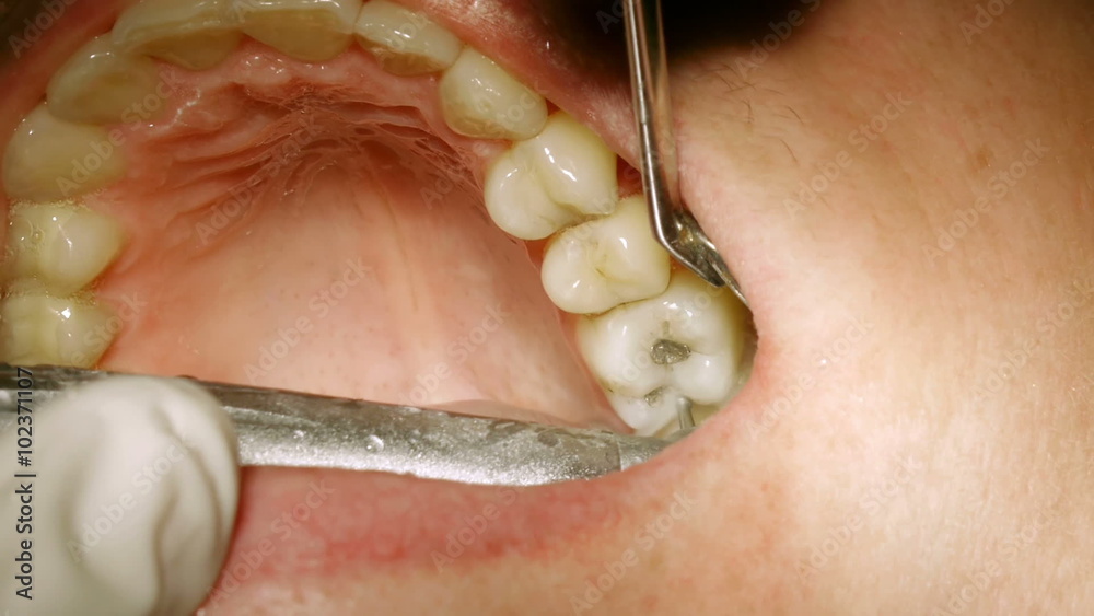 Dentist Drilling And Removing Old Fillings in Molars Stock Video