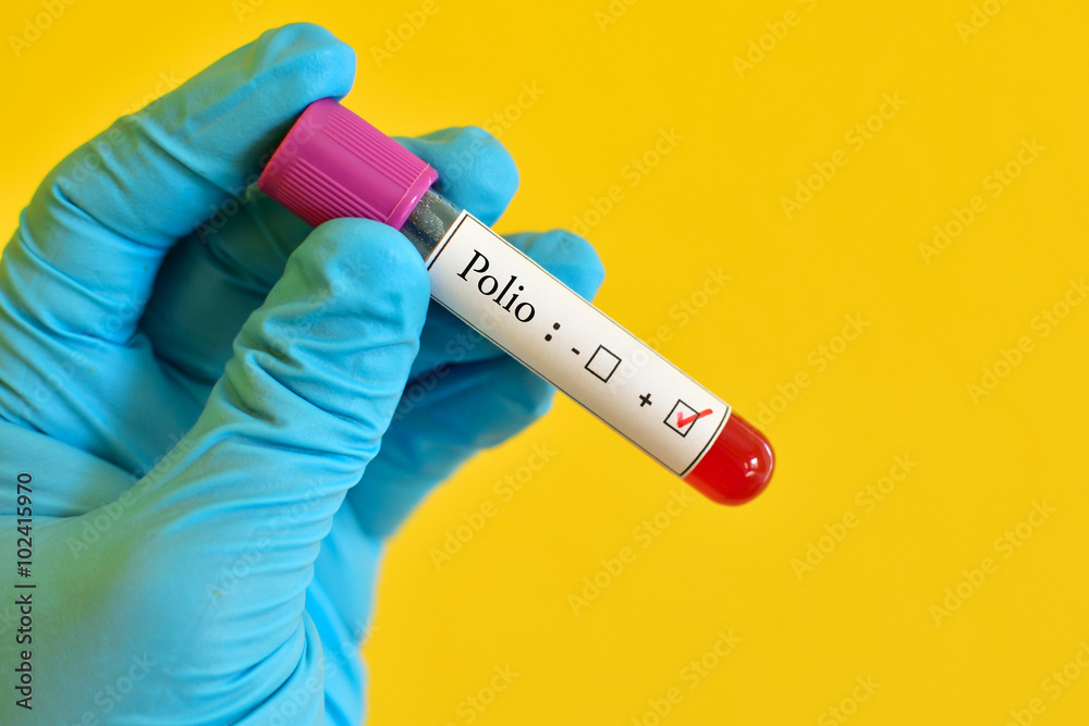 Obraz premium Polio virus positive