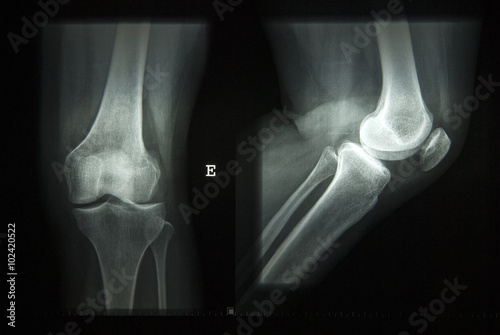 x-ray image normal knee