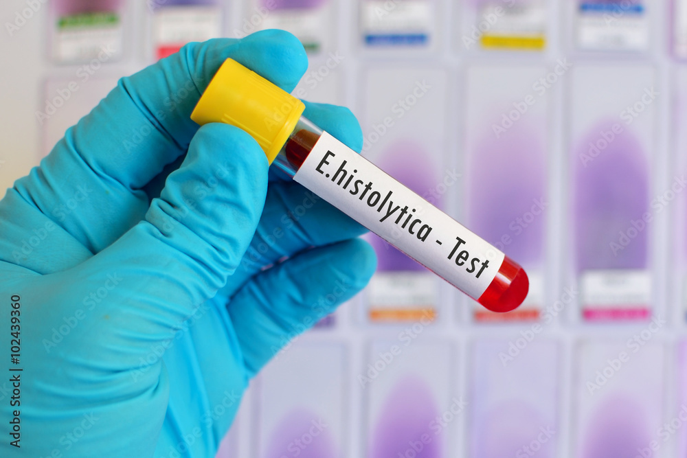 Blood sample for Entamoeba histolytica (E.histolytica) test Stock Photo