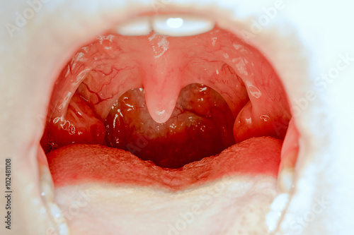 Cuadro en lienzo Closeup view of open mouth with tonsils