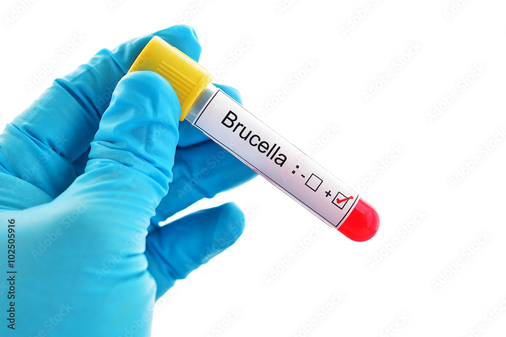 Obraz premium Blood sample positive with Brucella bacteria infected test