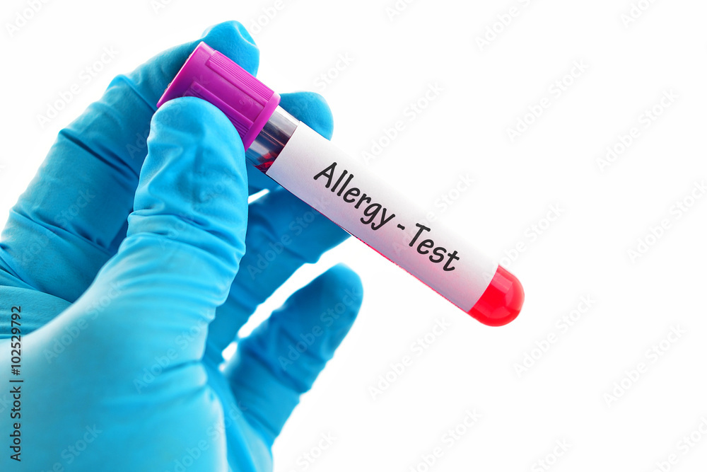 Obraz premium Blood sample for allergy testing