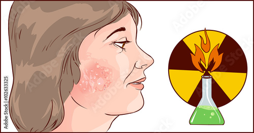 Vector illustration of a chemical burns to face