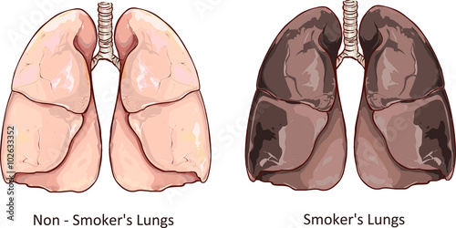 Vector illustration of a Healthy Lung and Smokers Lung