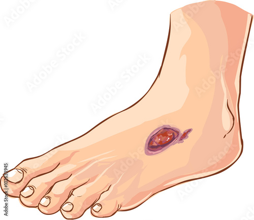  Vector illustration of a medical Diabetic foot
