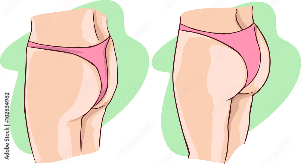 green background Vector illustration of a buttocks implants green background Vector illustration of a buttocks implants
