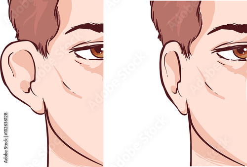  white backround Vector illustration of a Ear Pinnin Otoplasty