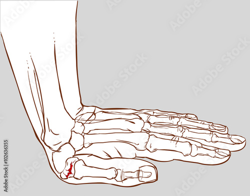 white background vector illustration of a hand fracture