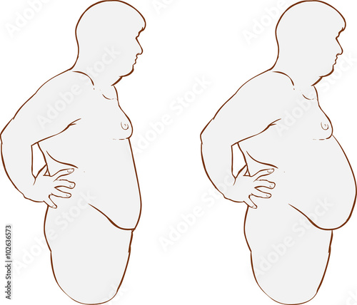 Vector illustration of a  Fat belly before and after treatment
