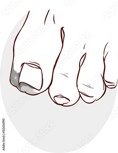 blue backround Vector illustration of a Ingrown Toenail