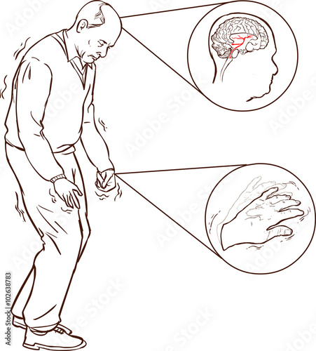 vector illustration of aOld man with Parkinson symptoms difficul