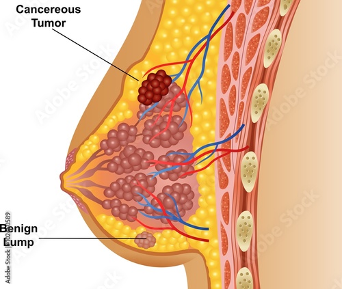 Illustration of cancerous breast tumor