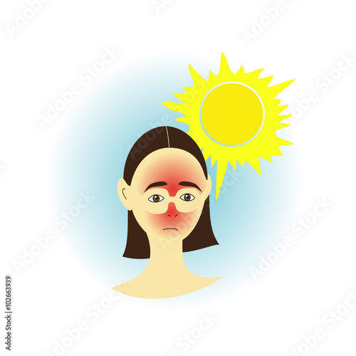 Sunburn