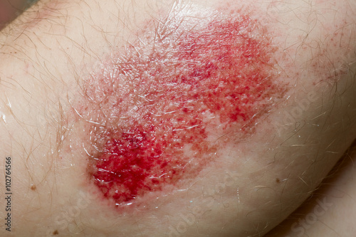 Close-up of a scratched wound on shoulder photo