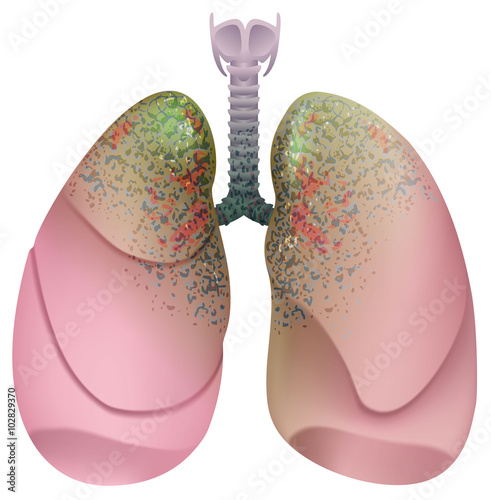 Respiratory system smoker. Lung cancer