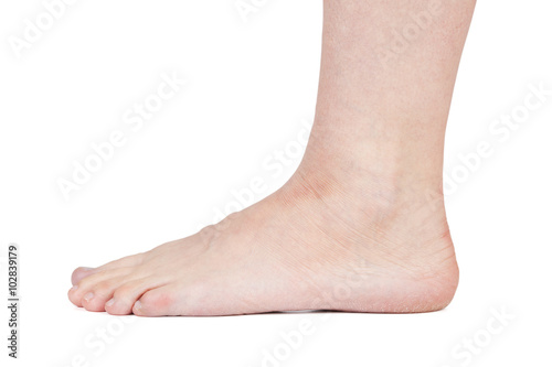 Foot of man with dry skin on a white background