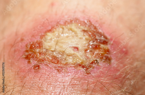 Nasty looking bruise shot, close-up