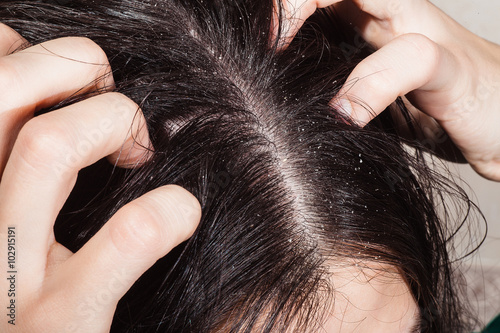 Fotótapéta Dander that causes itching scalp