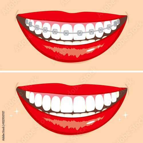 Illustration of two happy smiles showing before and after whitening teeth process