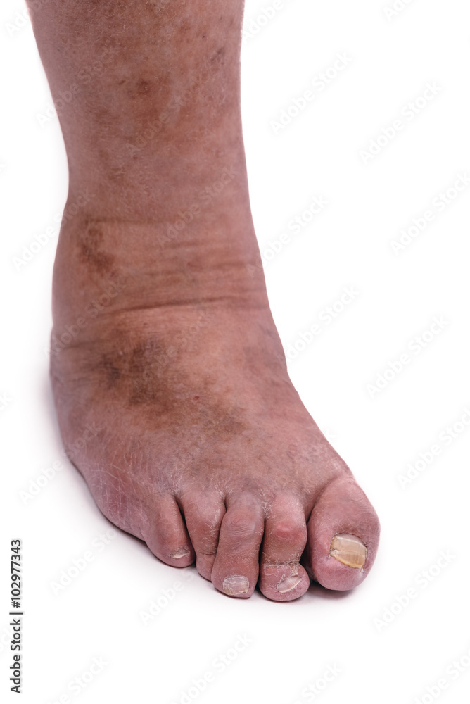Man with a diagnosis of polyarthritis . Man with a diagnosis of polyarthritis .
