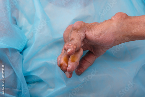 Man with a diagnosis of polyarthritis . photo