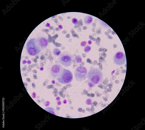 Mesothelial malignant cells with multiple nuclei