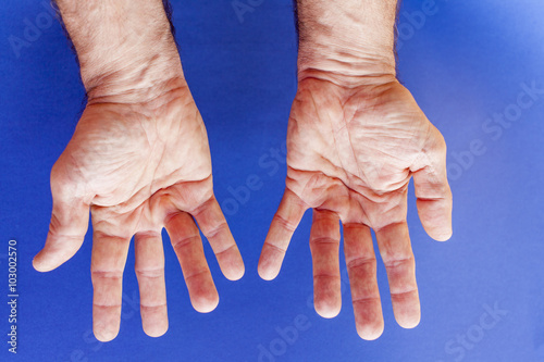 Obraz na plátně Hands of an man with Dupuytren contracture disease  against  medical blue backgr