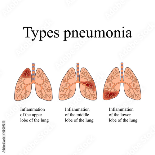 Pneumonia. The anatomical structure of the human lung. Type of pneumonia.  Vector illustration on isolated background